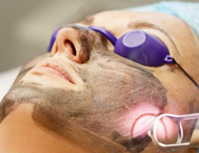 laser carbon facial in indore, laser facial in indore, laser treatment for face in indore