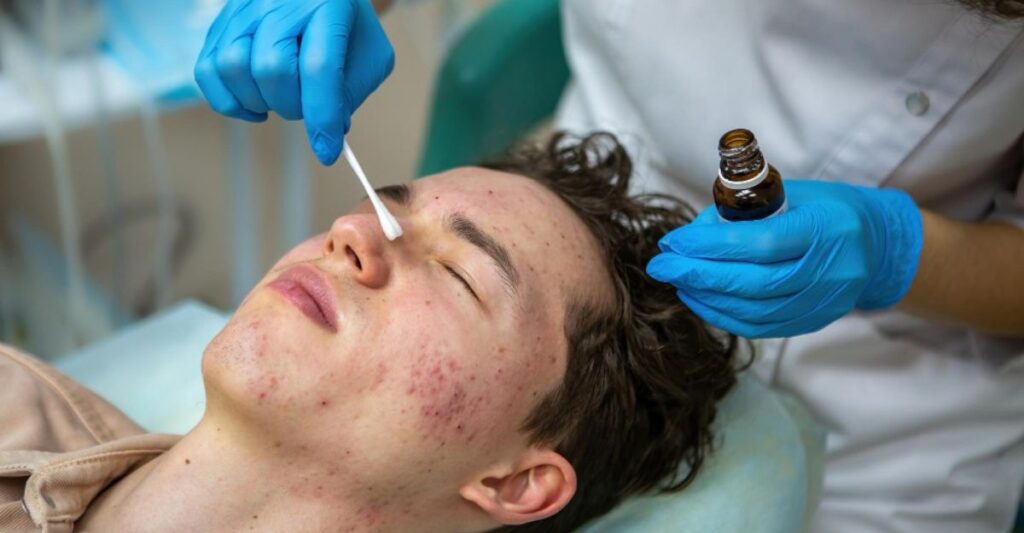 best acne care in Indore