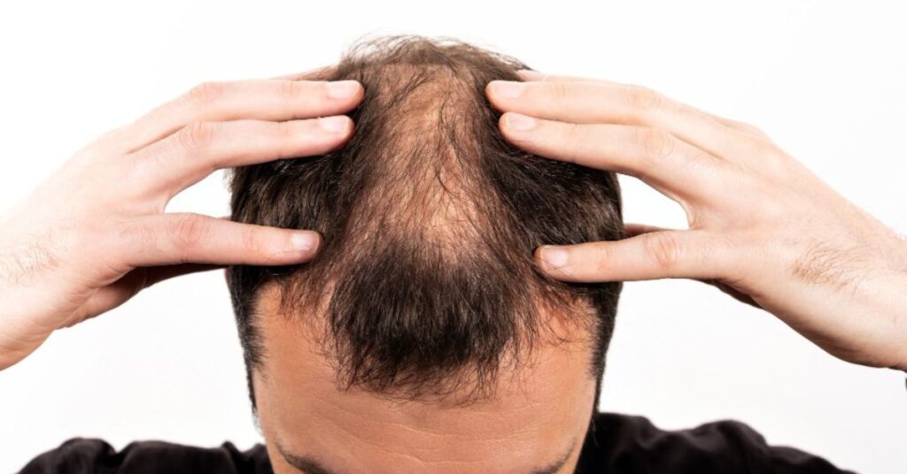  hair fall treatment in indore