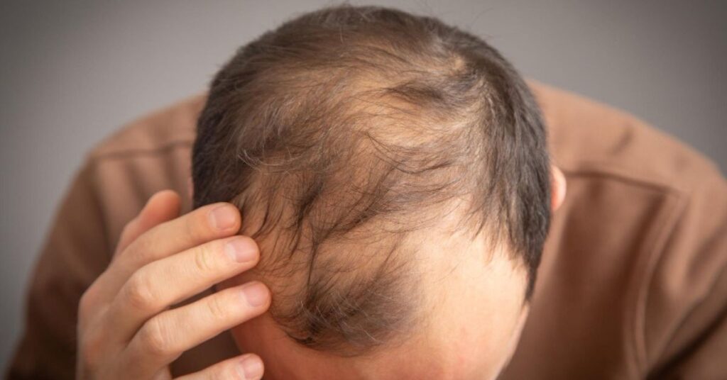 PRP hair therapy in indore