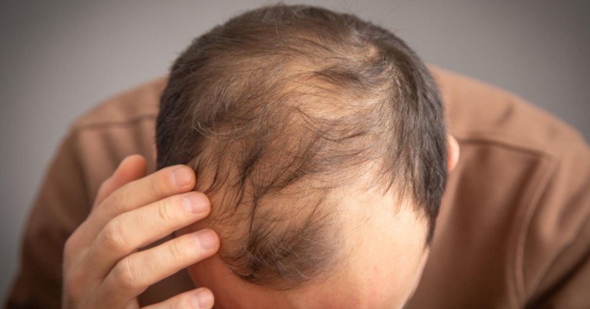 PRP hair therapy in indore