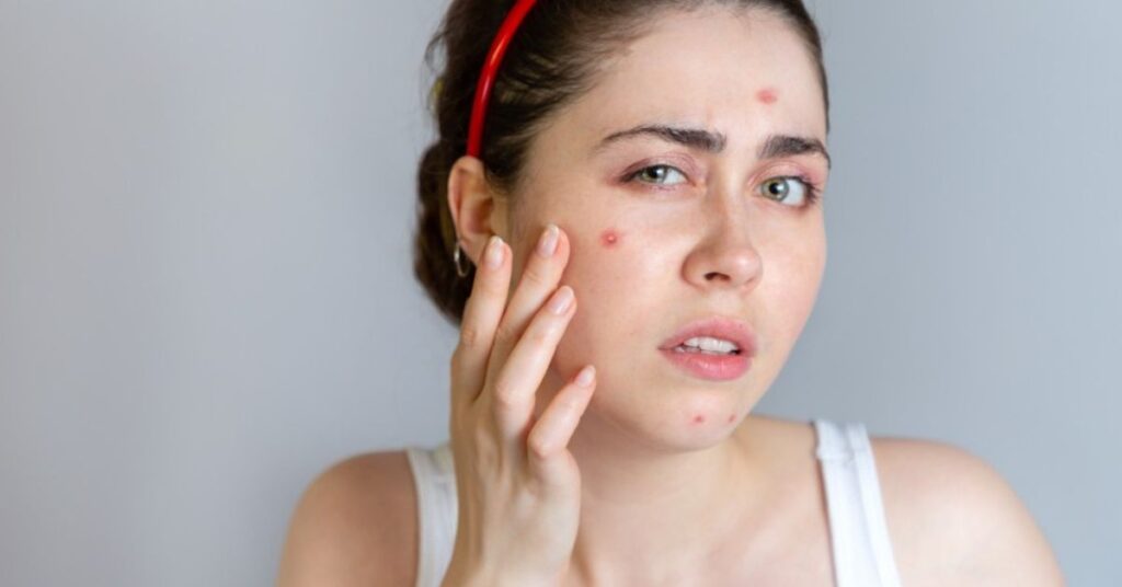 best acne care in indore