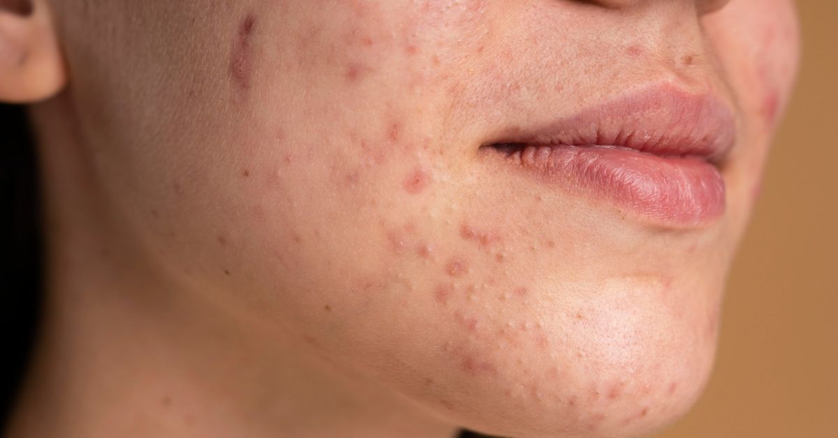 Acne scar reduction in Indore with acne scar laser treatment in Indore for improving skin texture and reducing marks